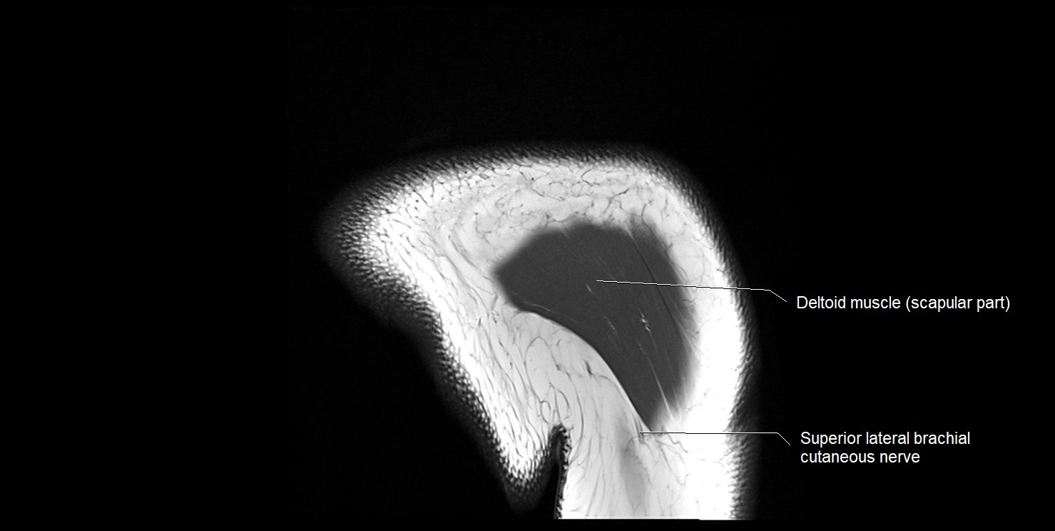mri shoulder coronal cross sectional anatomy image 22.webp